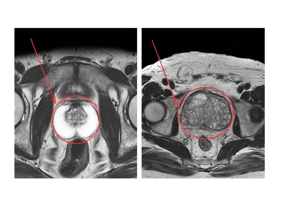 Sveikos (kairėje) ir uždegiminėje (dešinėje) prostatos palyginimas MRT vaizduose